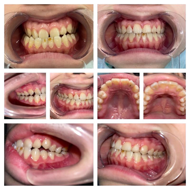 正畸期间牙齿间隙变大是正常现象吗？-图3