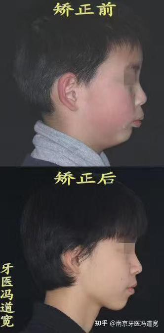 颌骨发育不足正畸，诊断方法如何影响矫治效果？-图1