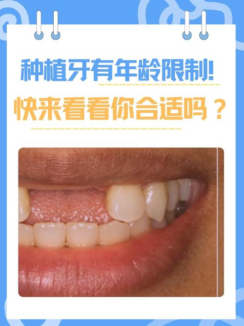 牙齿缺失后,种牙是可行的修复方案吗?-图2 牙齿缺失后,种牙是可行的修复方案吗?-图2