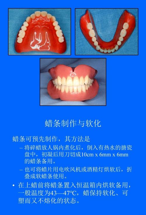 活动义齿冲胶的正确操作步骤是什么?-图1 活动义齿冲胶的正确操作步骤是什么?-图1