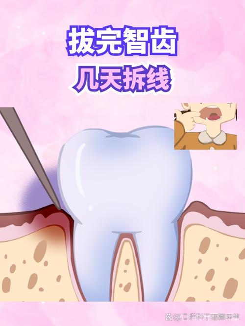 口腔内拆线怎么拆才正确?拆线后要注意什么?-图1 口腔内拆线怎么拆才正确?拆线后要注意什么?-图1