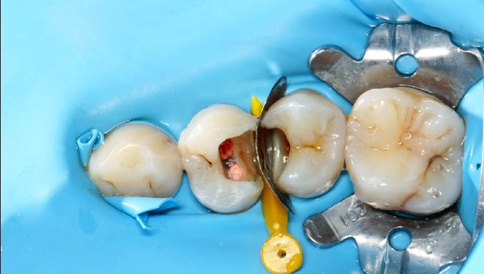 树脂充填的方法有哪些主要类型及应用？-图3