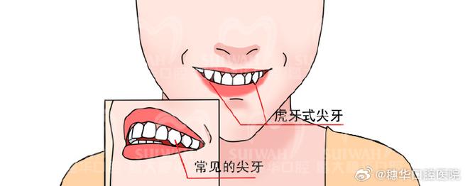 正畸尖牙中性关系标志-图3