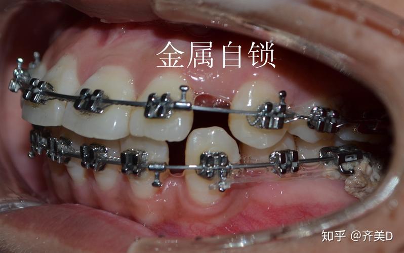 正畸结扎圈怎么放？视频教你正确步骤！-图2