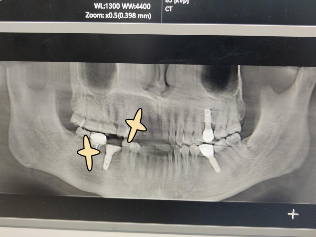 种牙材料会影响核磁共振检查吗？-图3