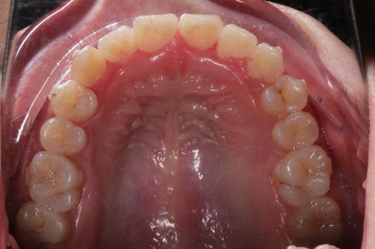 正畸口内像具体包括哪几张标准口内照片？-图2