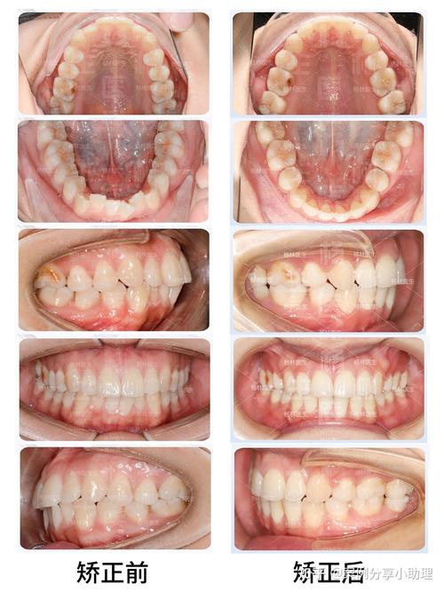 正畸口内像具体包括哪几张标准口内照片？-图3