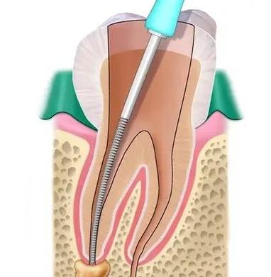 牙齿栓道安装的具体步骤和注意事项有哪些？-图3