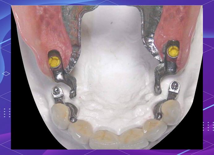 牙齿栓道安装的具体步骤和注意事项有哪些？-图2