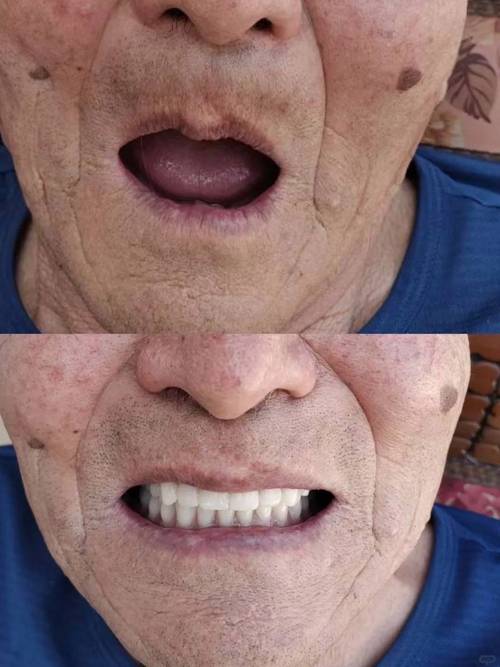 满口无牙做种植牙,究竟需要种几颗才合适?-图1 满口无牙做种植牙,究竟需要种几颗才合适?-图1