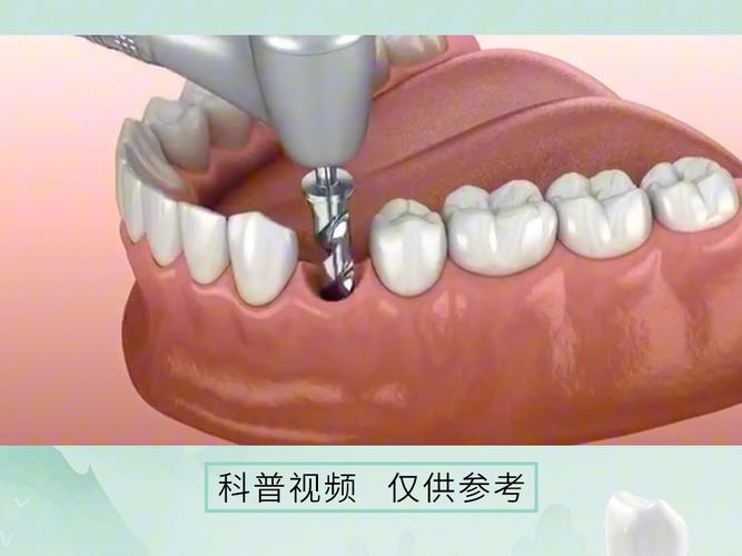 种牙安装过程视频，具体步骤是怎么操作的？-图1