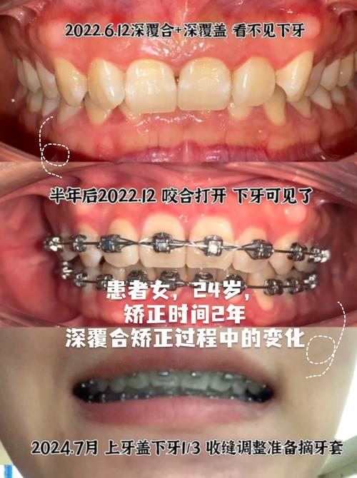 正畸矫正会导致牙齿松动吗？矫正后会恢复稳固吗？-图1