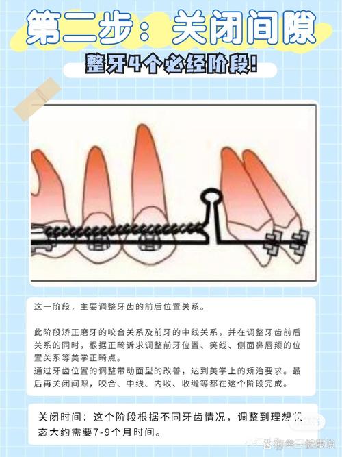 关闭牙间隙的常用方法有哪些？-图1