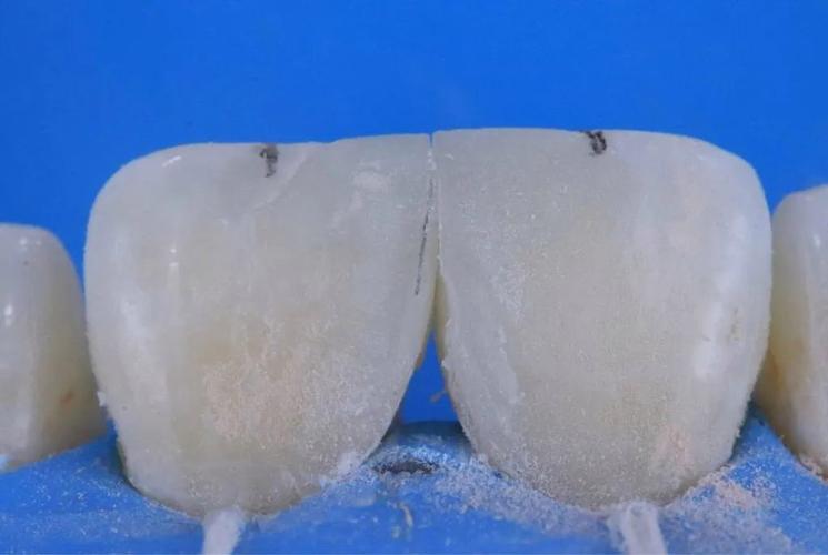 关闭牙间隙的常用方法有哪些？-图2