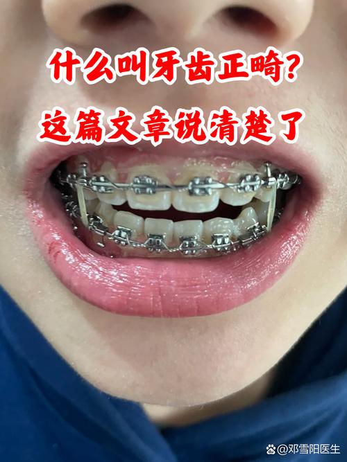 正畸收尾时压低牙齿是必要步骤吗？-图2