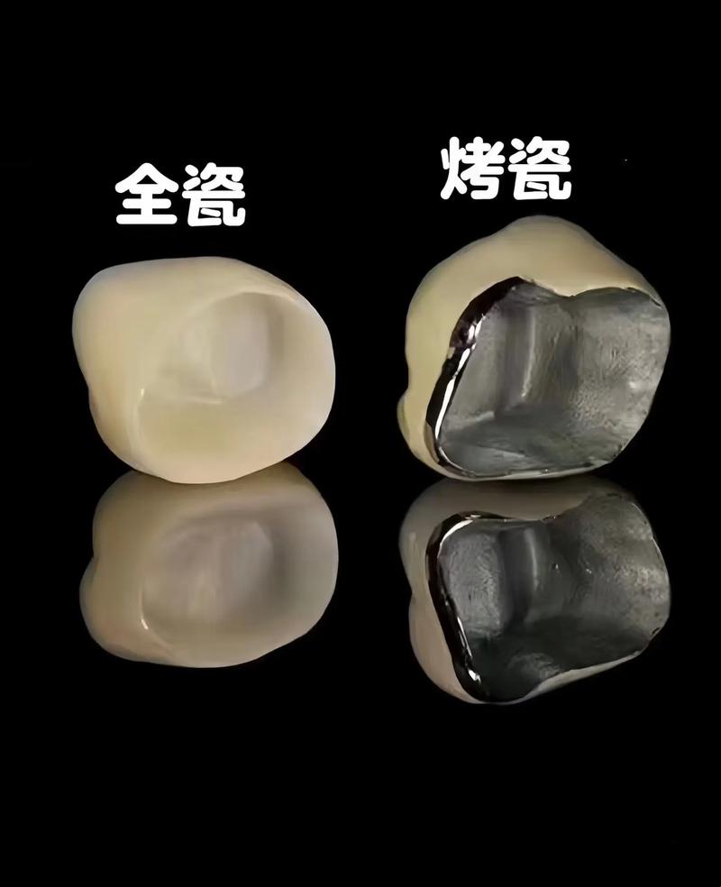 烤瓷冠试戴的正确方法有哪些？-图1