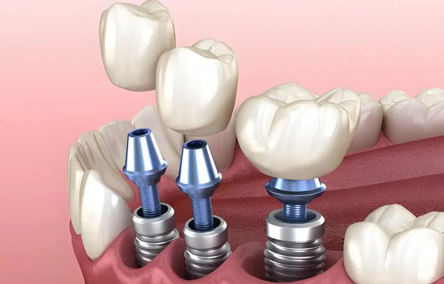 韩国安种宝种植牙效果怎么样？值得选吗？-图1