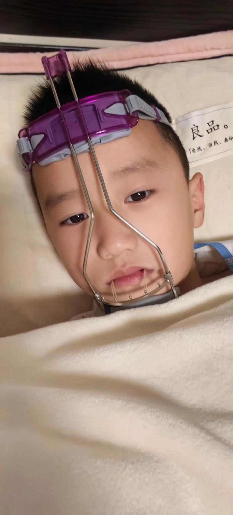 儿童乳牙滞留正畸牵引如何有效进行？-图1