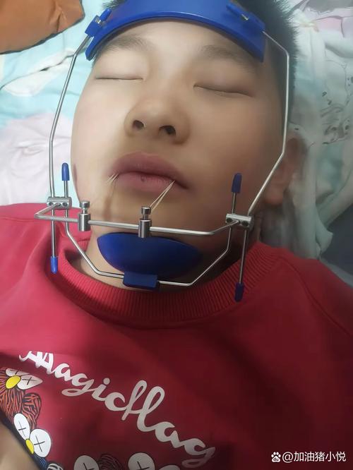 儿童乳牙滞留正畸牵引如何有效进行？-图3