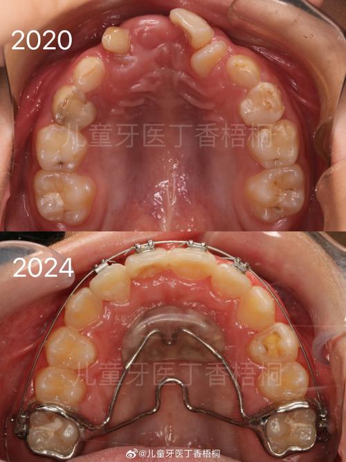 儿童乳牙滞留正畸牵引如何有效进行？-图2