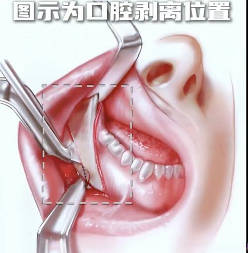 口腔诊所引流方法，哪些更实用有效？-图1