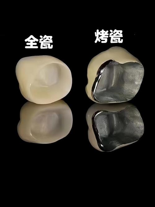 烤瓷牙与种植牙如何选？哪种更适合长期使用？-图3