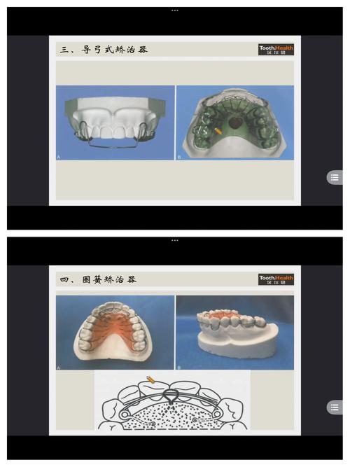 正畸模型制作的关键步骤与注意事项有哪些？-图1