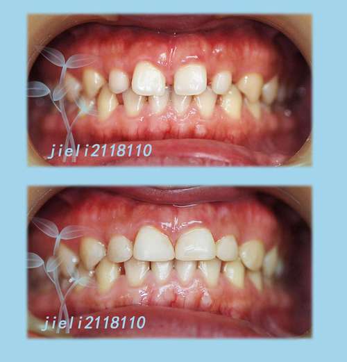 正畸磨牙近移间隙关闭，如何高效精准实现？-图1