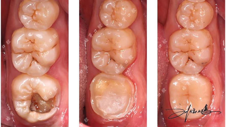 正畸期间嵌体修复可行吗？需注意哪些问题？-图2