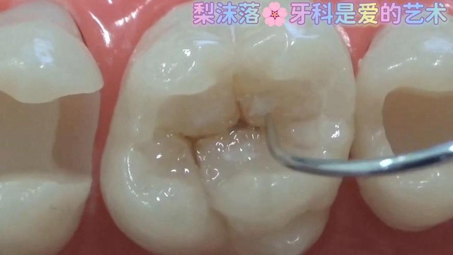 儿童后牙充填方法-图2