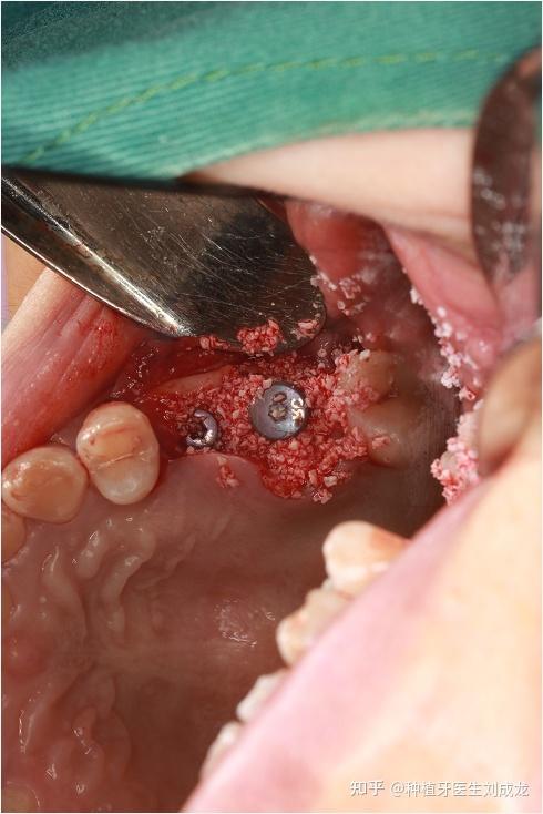 种牙植骨粉后照片能看出恢复效果吗？-图3