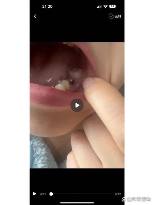 种牙植骨粉后照片能看出恢复效果吗？-图1