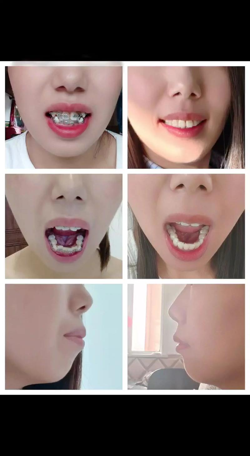 正畸矫治后复发的图片-图1