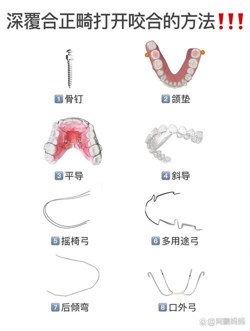 正畸种植支抗打开咬合的原理与效果如何？-图2