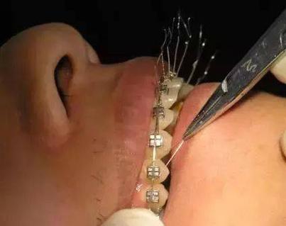 正畸悬吊结扎如何操作？关键步骤与技巧解析-图2