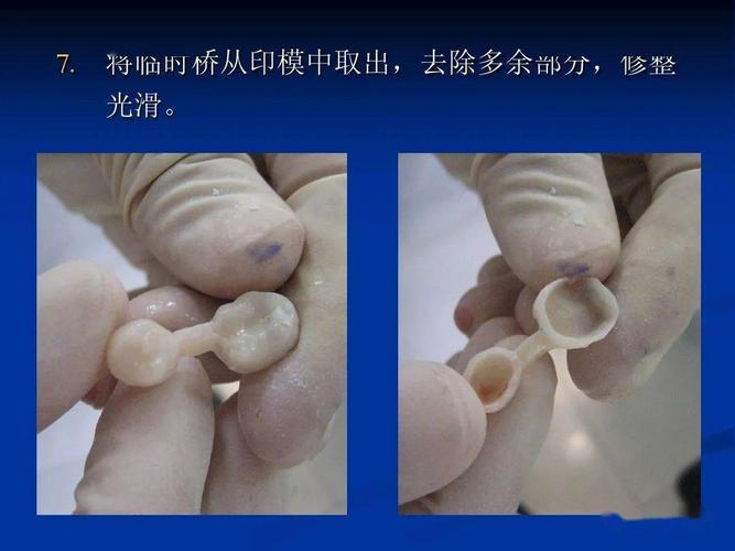 临时冠制作的具体方法及操作步骤有哪些？-图3