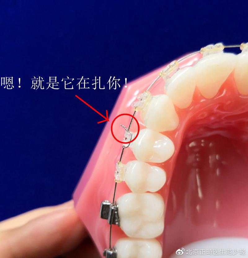 正畸上结扎丝方法-图1 正畸上结扎丝方法-图1
