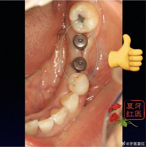 种牙前增骨有必要吗？为何不能直接种植？-图3