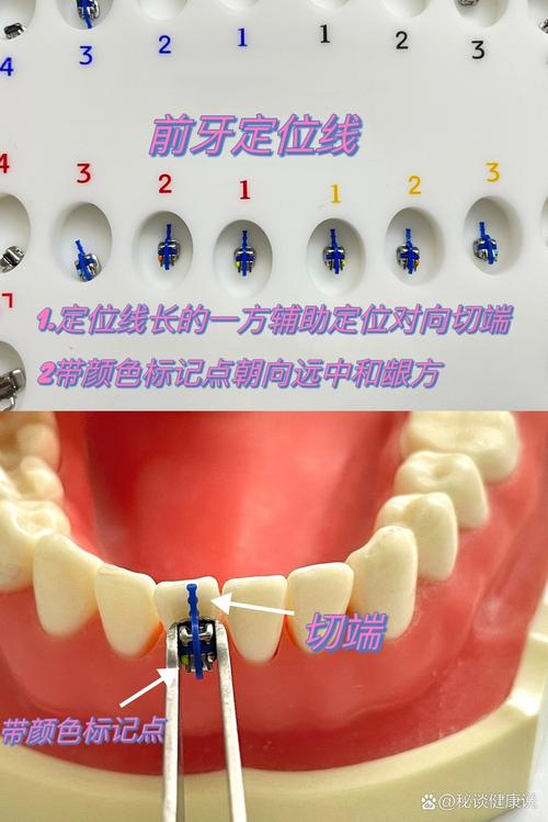 护士正畸粘托槽流程的关键步骤有哪些?-图3 护士正畸粘托槽流程的关键步骤有哪些?-图3