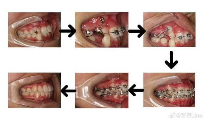 正畸尖牙回扎方法-图1