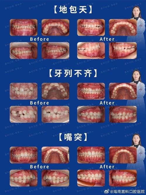 正畸治疗中牙列拥挤的分类标准及意义是什么？-图1