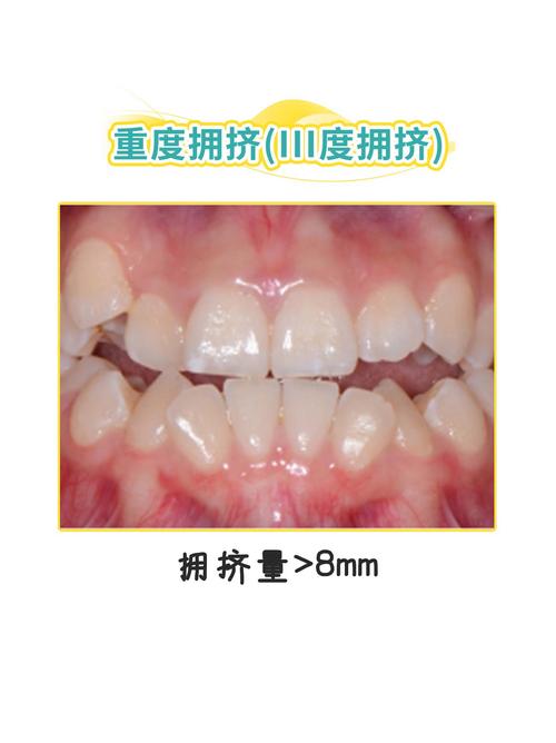 正畸治疗中牙列拥挤的分类标准及意义是什么？-图3