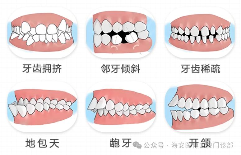 正畸治疗中牙列拥挤的分类标准及意义是什么？-图2
