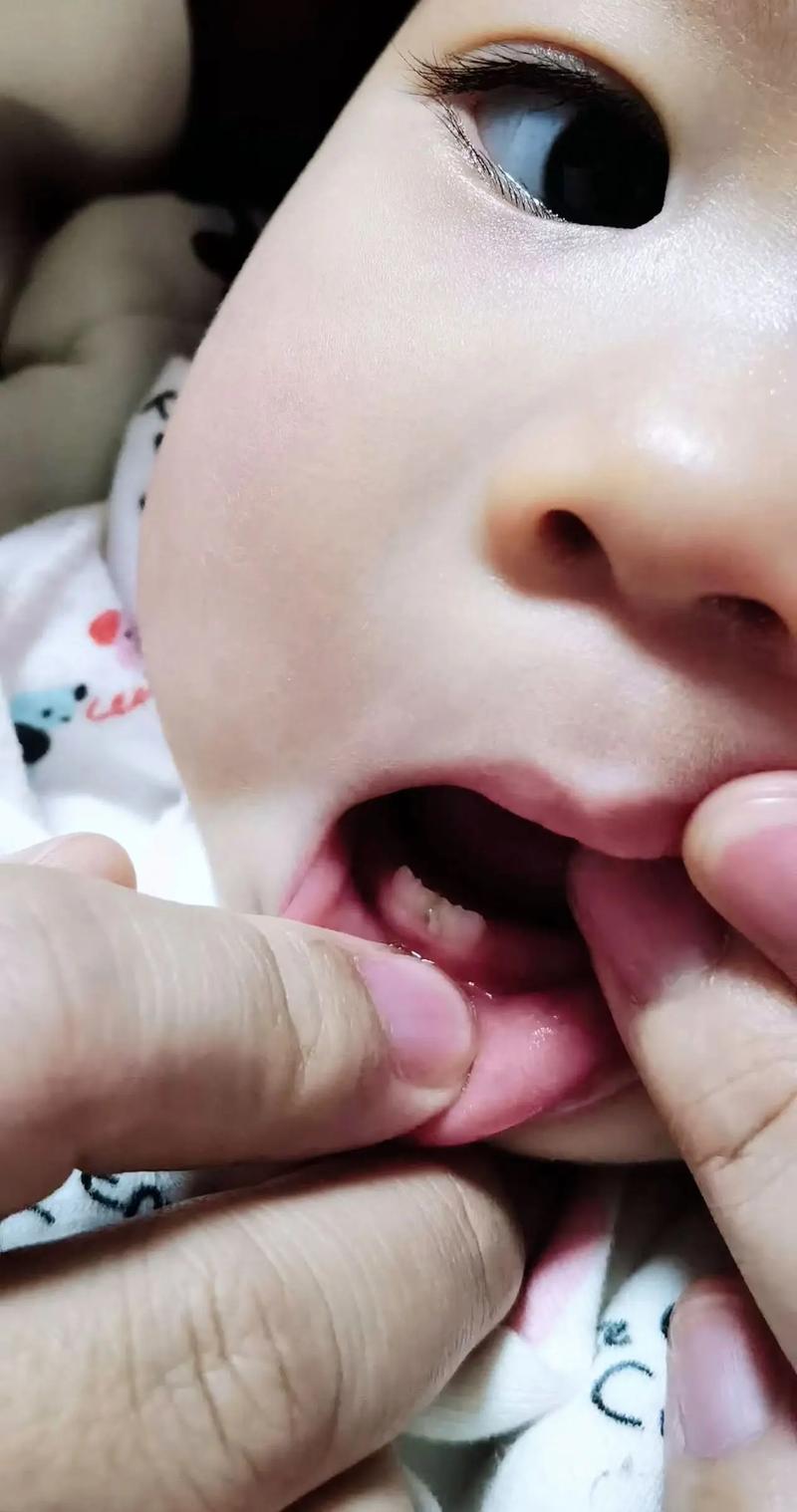 种完牙吃东西总塞牙，是种植体不贴合吗？-图3