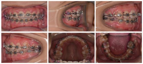 牙龈发炎会影响正畸治疗的顺利进行吗？-图2