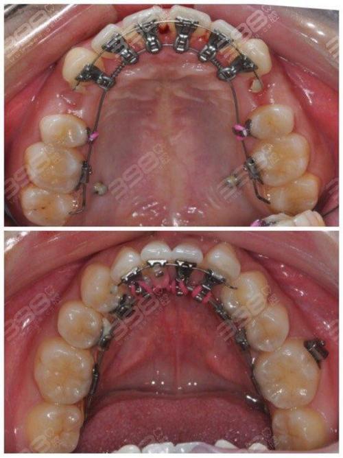 深圳牙科医院牙齿正畸哪家好？效果和价格如何？-图2