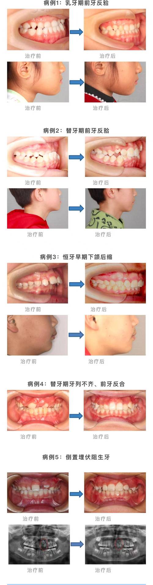 正畸侧切牙小咬合错位-图1 正畸侧切牙小咬合错位-图1