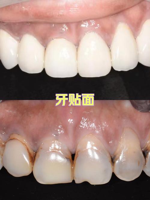牙齿贴面去除方法-图3