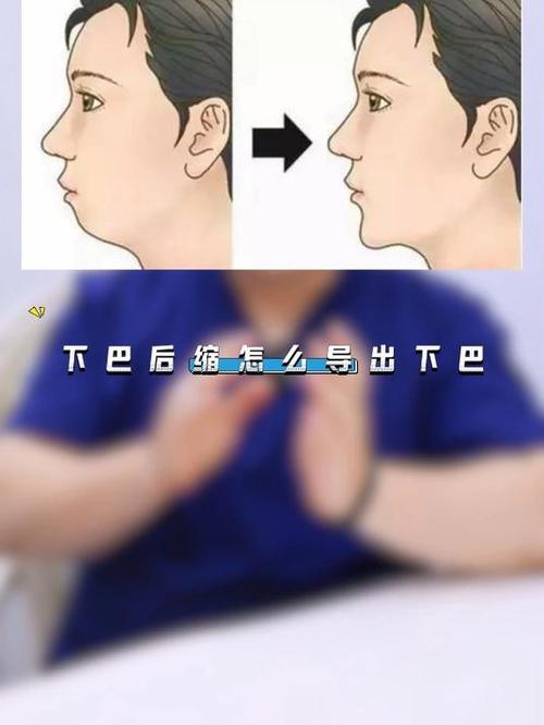 下颌曲线反了，正畸矫正有哪些注意事项？-图3