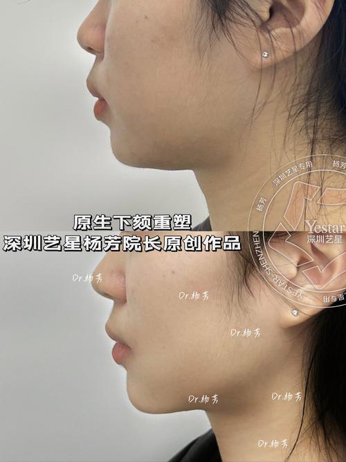 下颌曲线反了，正畸矫正有哪些注意事项？-图2